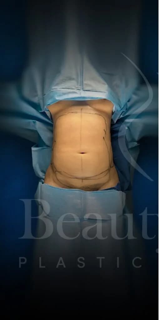 Liposucción y Lipo 360 antes por Dr. Oliver Simmons en Miami · Beautyland Plastic Surgery