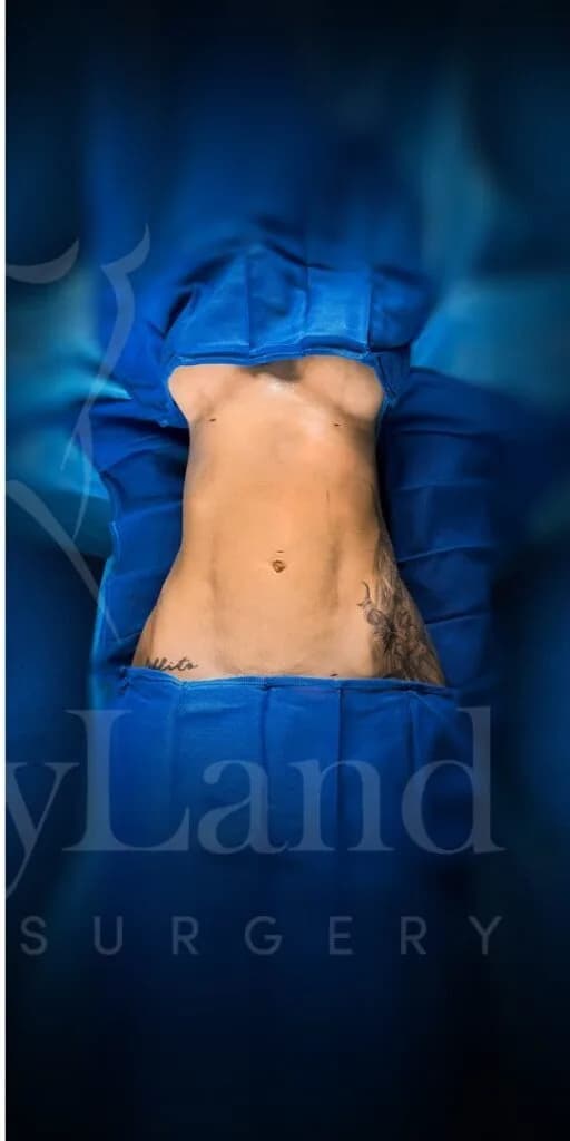Liposucción y Lipo 360 después por Dr. Oliver Simmons en Miami · Beautyland Plastic Surgery