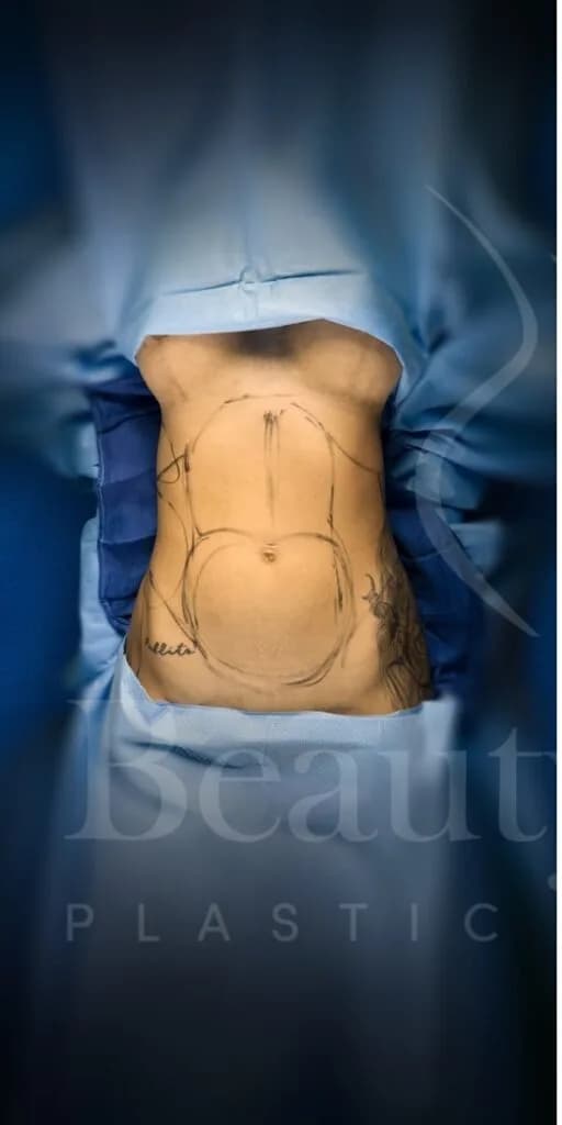 Liposucción y Lipo 360 antes por Dr. Oliver Simmons en Miami · Beautyland Plastic Surgery
