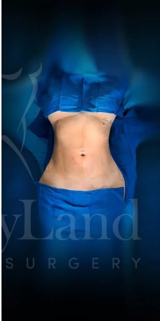Liposucción y Lipo 360 después por Dr. Oliver Simmons en Miami · Beautyland Plastic Surgery