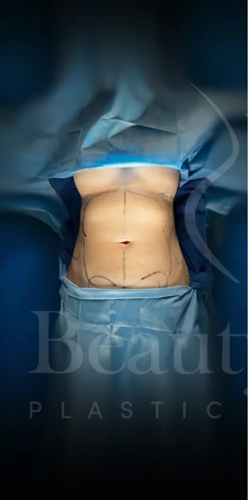 Liposucción y Lipo 360 antes por Dr. Oliver Simmons en Miami · Beautyland Plastic Surgery