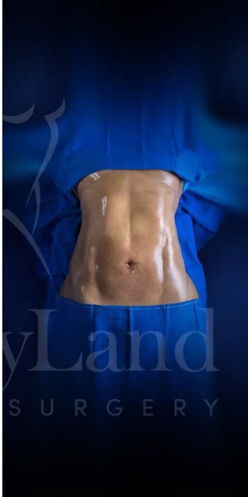 Liposucción y Lipo 360 después por Dr. Oliver Simmons en Miami · Beautyland Plastic Surgery