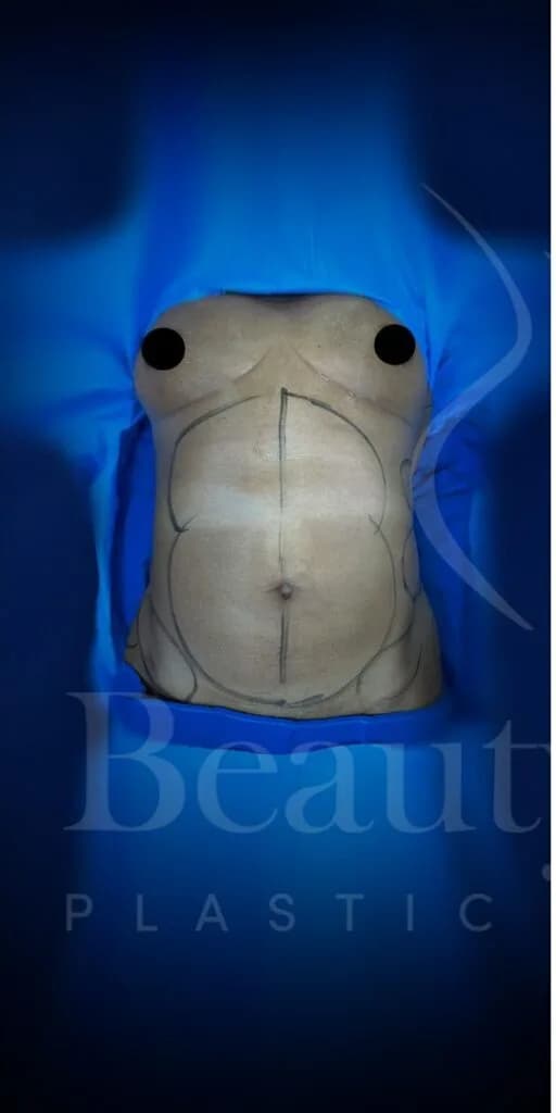 Liposucción y Lipo 360 antes por Dr. Oliver Simmons en Miami · Beautyland Plastic Surgery
