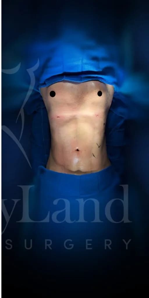 Liposucción y Lipo 360 después por Dr. Oliver Simmons en Miami · Beautyland Plastic Surgery