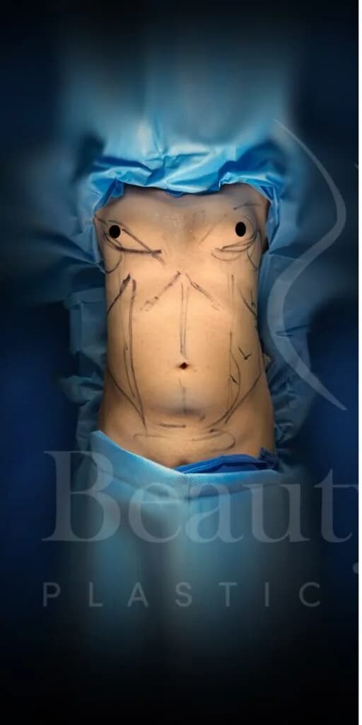 Liposucción y Lipo 360 antes por Dr. Oliver Simmons en Miami · Beautyland Plastic Surgery