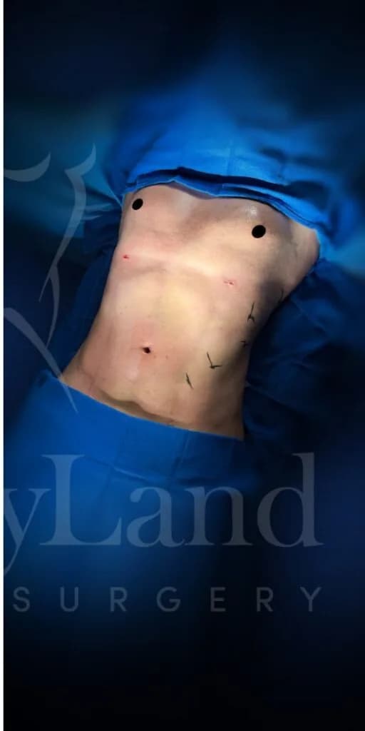 Liposucción y Lipo 360 después por Dr. Oliver Simmons en Miami · Beautyland Plastic Surgery