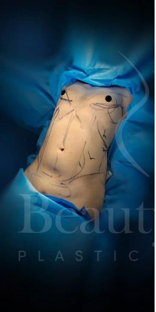 Liposucción y Lipo 360 antes por Dr. Oliver Simmons en Miami · Beautyland Plastic Surgery