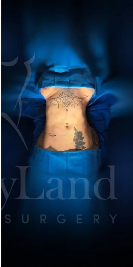 Liposucción y Lipo 360 después por Dr. Oliver Simmons en Miami · Beautyland Plastic Surgery
