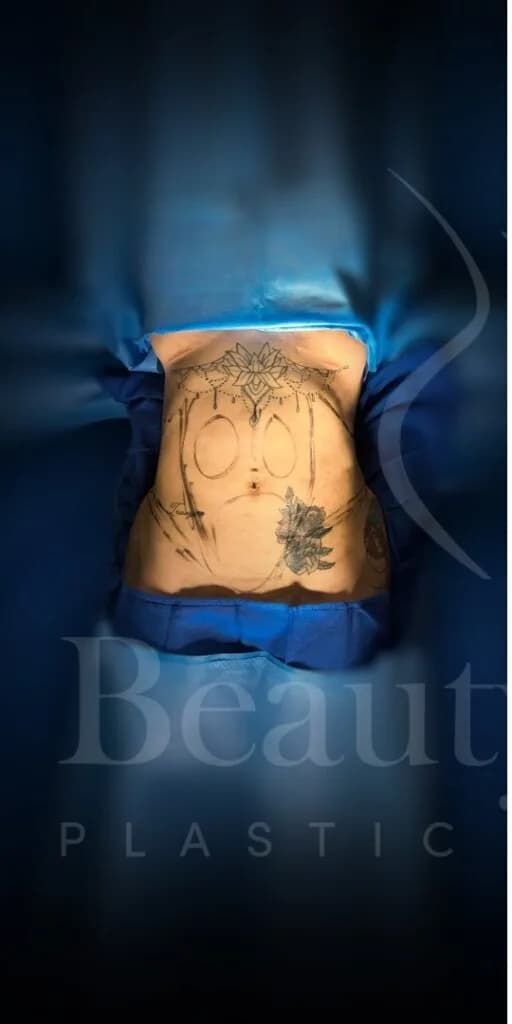Liposucción y Lipo 360 antes por Dr. Oliver Simmons en Miami · Beautyland Plastic Surgery