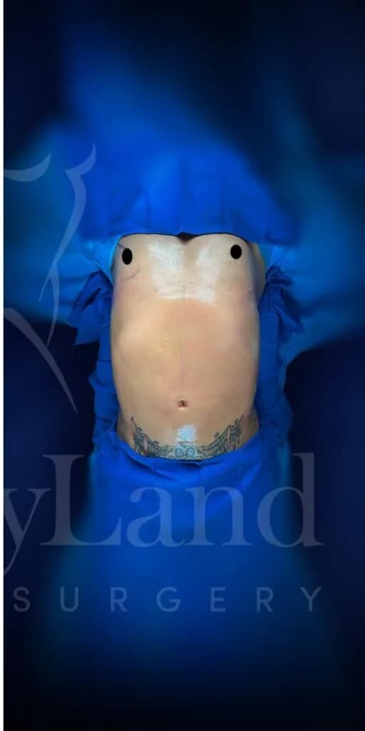 Liposucción y Lipo 360 después por Dr. Oliver Simmons en Miami · Beautyland Plastic Surgery