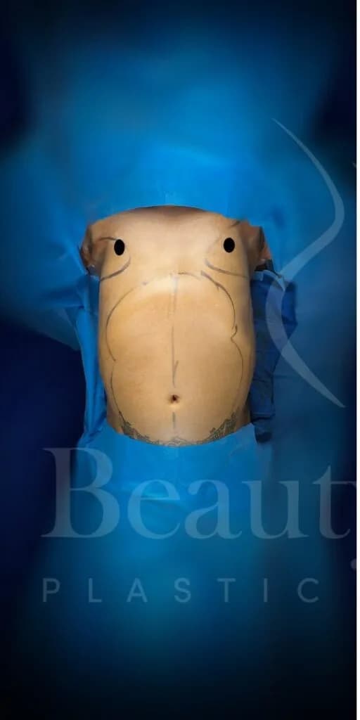 Liposucción y Lipo 360 antes por Dr. Oliver Simmons en Miami · Beautyland Plastic Surgery