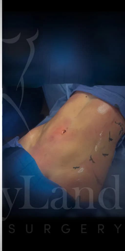 Liposucción y Lipo 360 después por Dr. Oliver Simmons en Miami · Beautyland Plastic Surgery