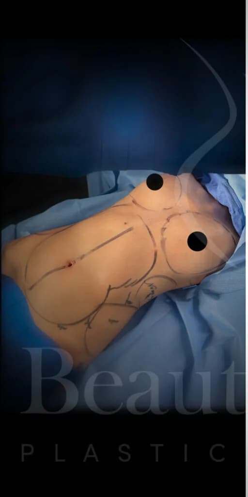 Liposucción y Lipo 360 antes por Dr. Oliver Simmons en Miami · Beautyland Plastic Surgery