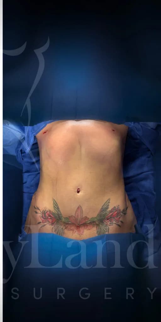 Liposucción y Lipo 360 después por Dr. Oliver Simmons en Miami · Beautyland Plastic Surgery