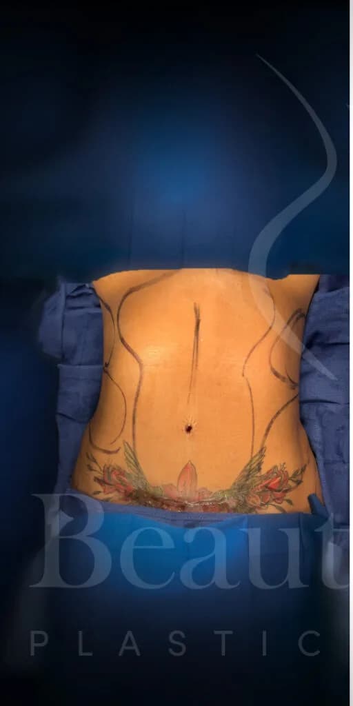 Liposucción y Lipo 360 antes por Dr. Oliver Simmons en Miami · Beautyland Plastic Surgery