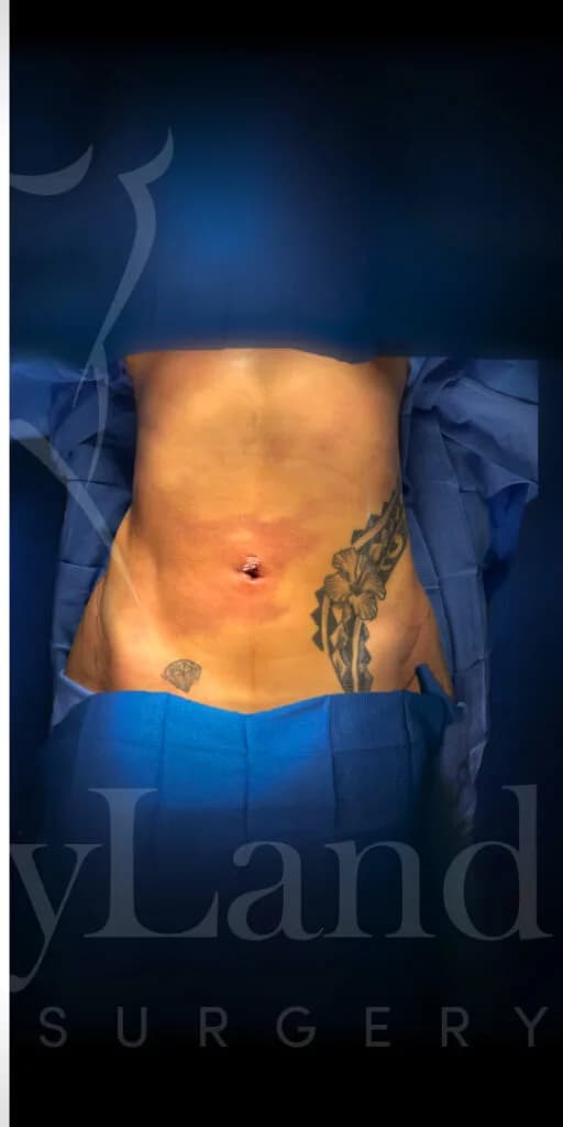 Liposucción y Lipo 360 después por Dr. Oliver Simmons en Miami · Beautyland Plastic Surgery