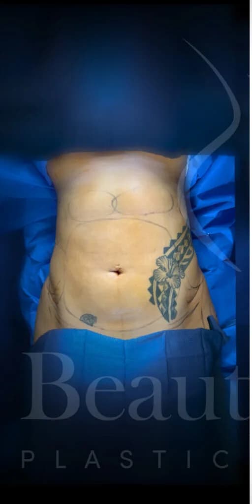 Liposucción y Lipo 360 antes por Dr. Oliver Simmons en Miami · Beautyland Plastic Surgery