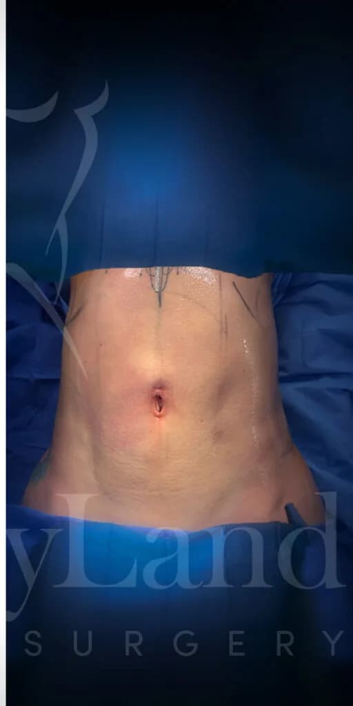 Liposucción y Lipo 360 después por Dr. Oliver Simmons en Miami · Beautyland Plastic Surgery