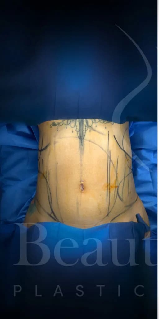 Liposucción y Lipo 360 antes por Dr. Oliver Simmons en Miami · Beautyland Plastic Surgery