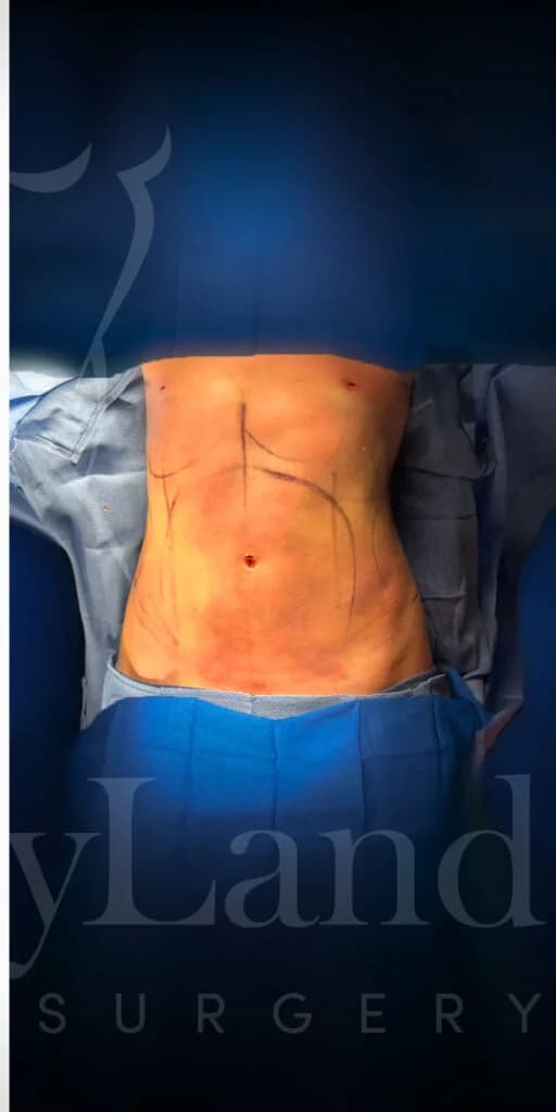 Liposucción y Lipo 360 después por Dr. Oliver Simmons en Miami · Beautyland Plastic Surgery