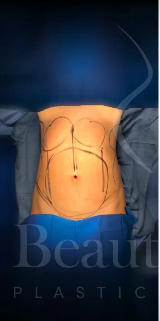 Liposucción y Lipo 360 antes por Dr. Oliver Simmons en Miami · Beautyland Plastic Surgery