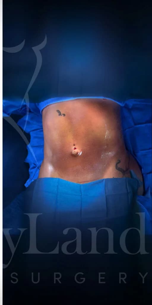 Liposucción y Lipo 360 después por Dr. Oliver Simmons en Miami · Beautyland Plastic Surgery