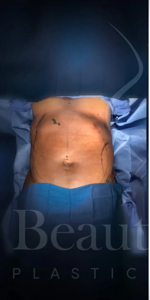 Liposucción y Lipo 360 antes por Dr. Oliver Simmons en Miami · Beautyland Plastic Surgery