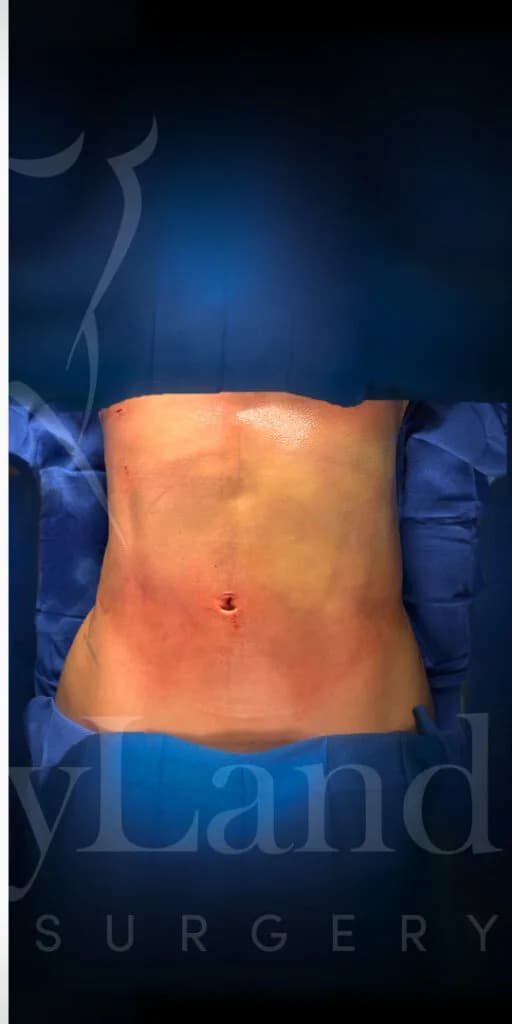 Liposucción y Lipo 360 después por Dr. Oliver Simmons en Miami · Beautyland Plastic Surgery