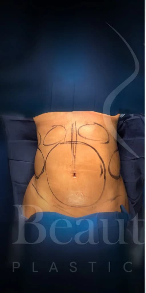 Liposucción y Lipo 360 antes por Dr. Oliver Simmons en Miami · Beautyland Plastic Surgery