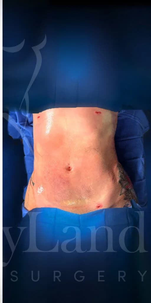 Liposucción y Lipo 360 después por Dr. Oliver Simmons en Miami · Beautyland Plastic Surgery