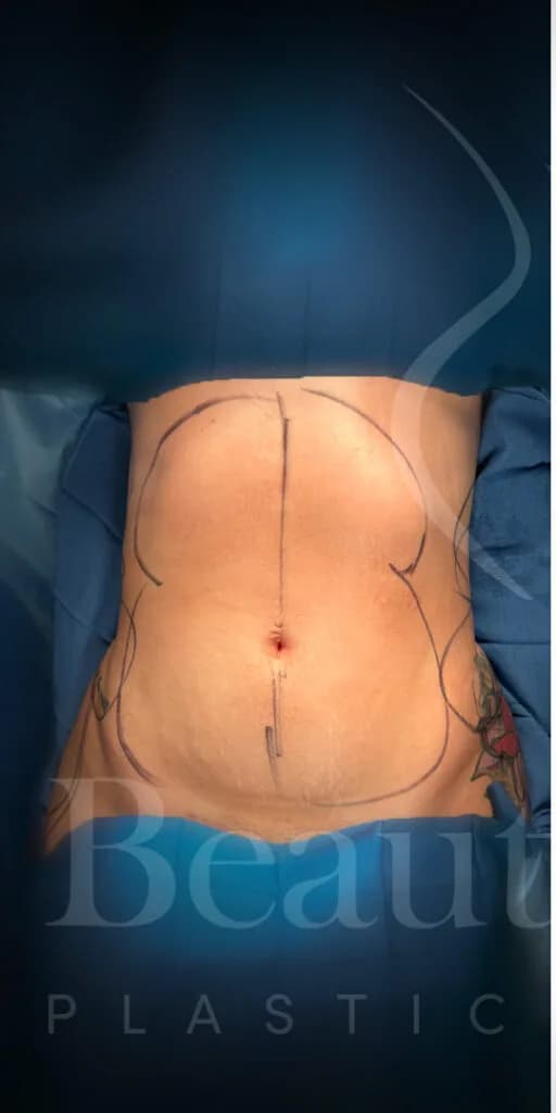 Liposucción y Lipo 360 antes por Dr. Oliver Simmons en Miami · Beautyland Plastic Surgery