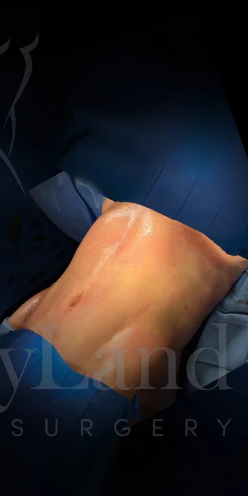 Liposucción y Lipo 360 después por Dr. Oliver Simmons en Miami · Beautyland Plastic Surgery