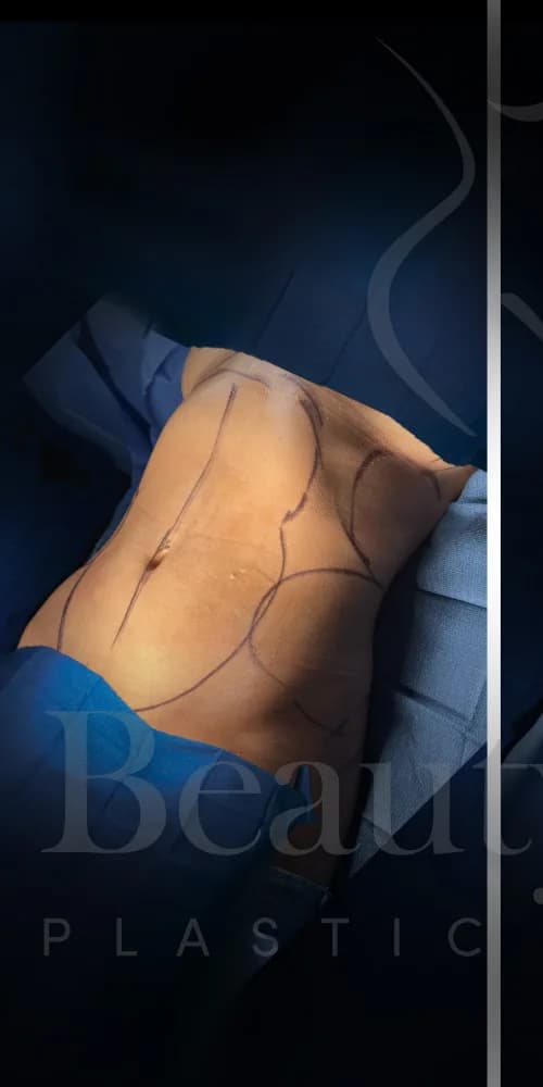 Liposucción y Lipo 360 antes por Dr. Oliver Simmons en Miami · Beautyland Plastic Surgery