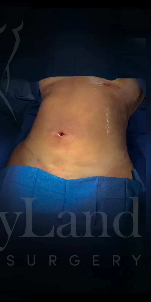 Liposucción y Lipo 360 después por Dr. Oliver Simmons en Miami · Beautyland Plastic Surgery