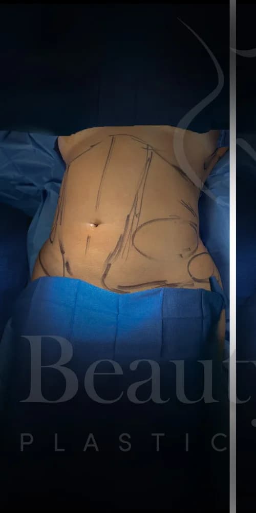 Liposucción y Lipo 360 antes por Dr. Oliver Simmons en Miami · Beautyland Plastic Surgery