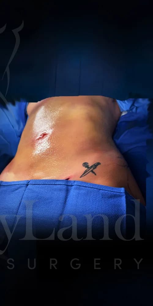 Liposucción y Lipo 360 después por Dr. Oliver Simmons en Miami · Beautyland Plastic Surgery