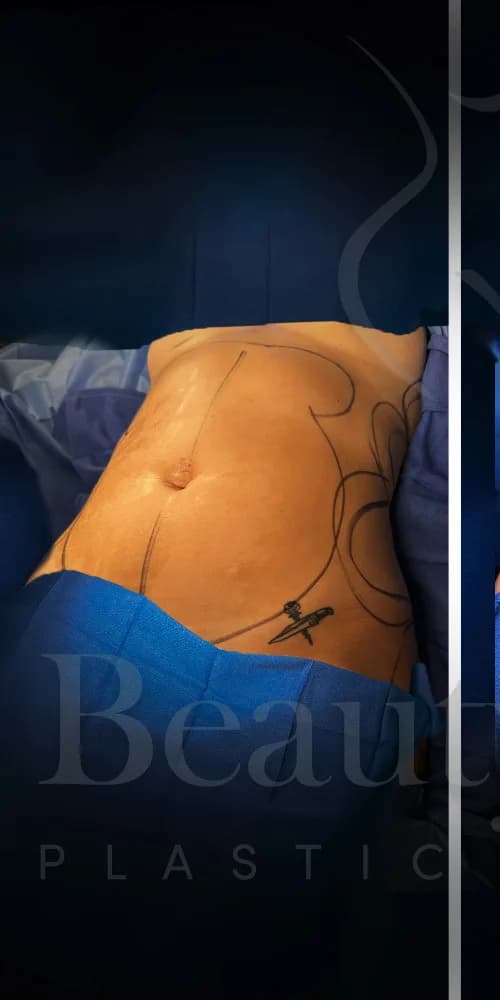 Liposucción y Lipo 360 antes por Dr. Oliver Simmons en Miami · Beautyland Plastic Surgery