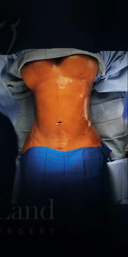 Liposucción y Lipo 360 después por Dr. Oliver Simmons en Miami · Beautyland Plastic Surgery