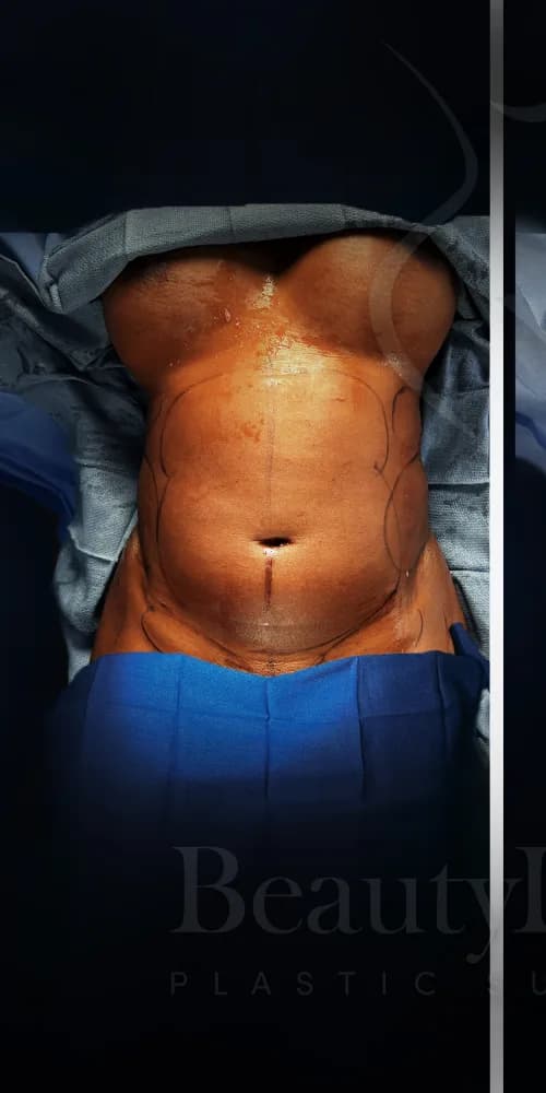 Liposucción y Lipo 360 antes por Dr. Oliver Simmons en Miami · Beautyland Plastic Surgery