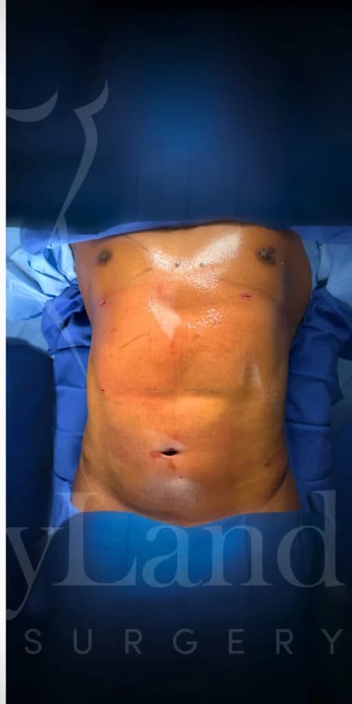 Liposucción y Lipo 360 después por Dr. Oliver Simmons en Miami · Beautyland Plastic Surgery