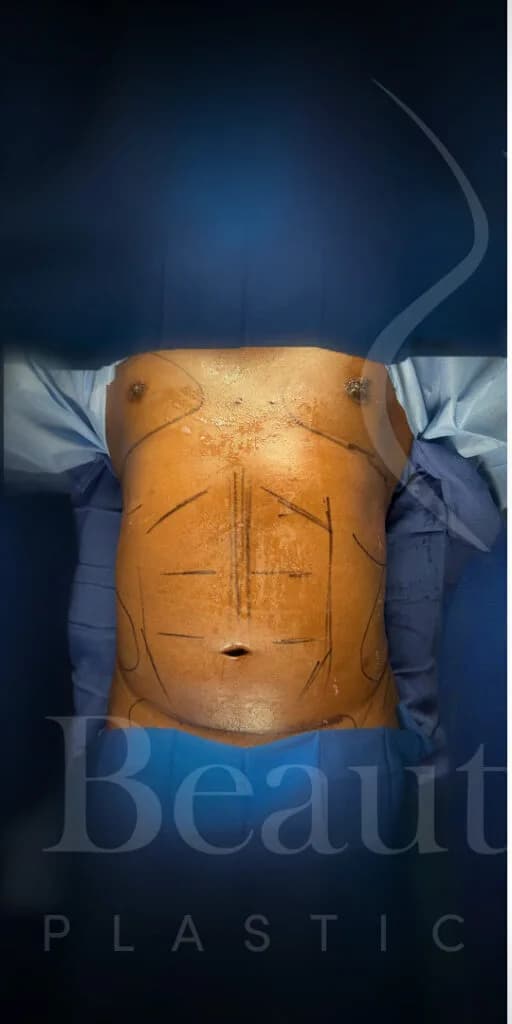 Liposucción y Lipo 360 antes por Dr. Oliver Simmons en Miami · Beautyland Plastic Surgery