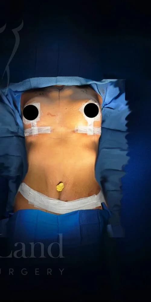 Mommy Makeover después por Dr. Anne-Sophie Lessard en Miami · Beautyland Plastic Surgery