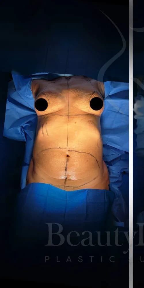 Mommy Makeover antes por Dr. Anne-Sophie Lessard en Miami · Beautyland Plastic Surgery