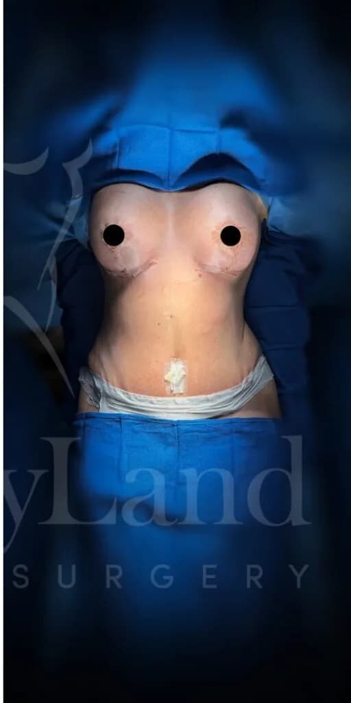 Mommy Makeover después por Dr. Oliver Simmons en Miami · Beautyland Plastic Surgery