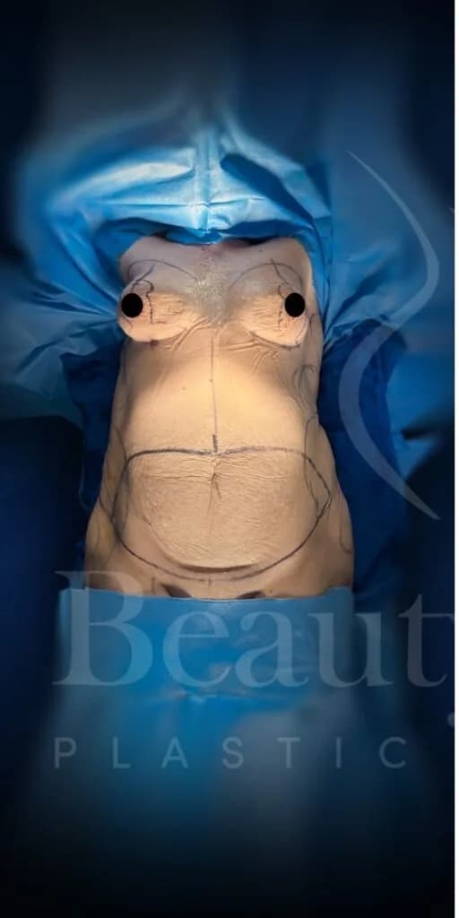 Mommy Makeover antes por Dr. Oliver Simmons en Miami · Beautyland Plastic Surgery