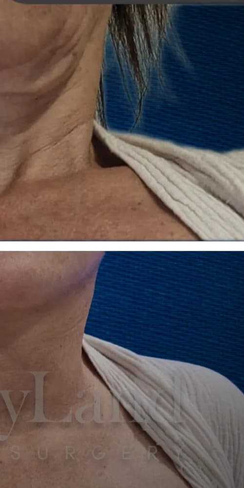 Lifting de cuello después por Dr. Oliver Simmons en Miami · Beautyland Plastic Surgery