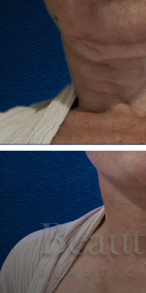 Lifting de cuello antes por Dr. Oliver Simmons en Miami · Beautyland Plastic Surgery