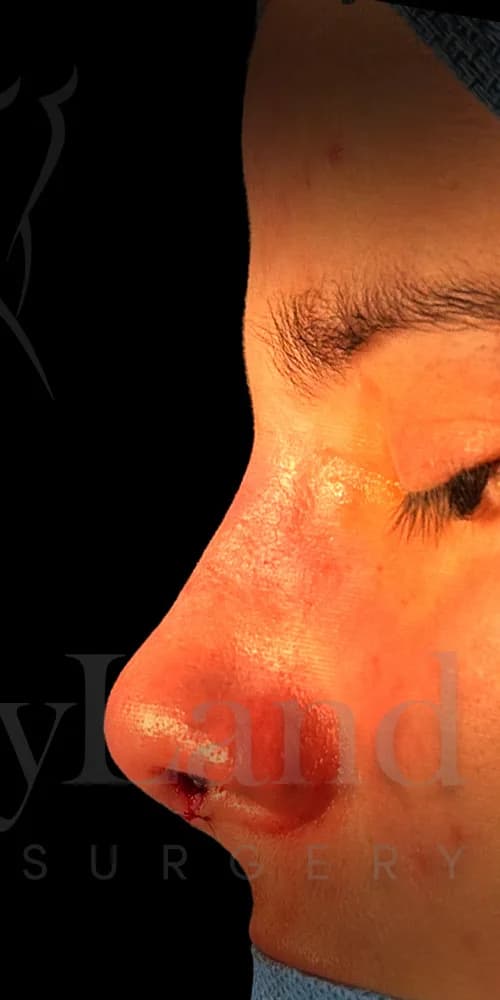 Rinoplastia después por Dr. Oliver Simmons en Miami · Beautyland Plastic Surgery