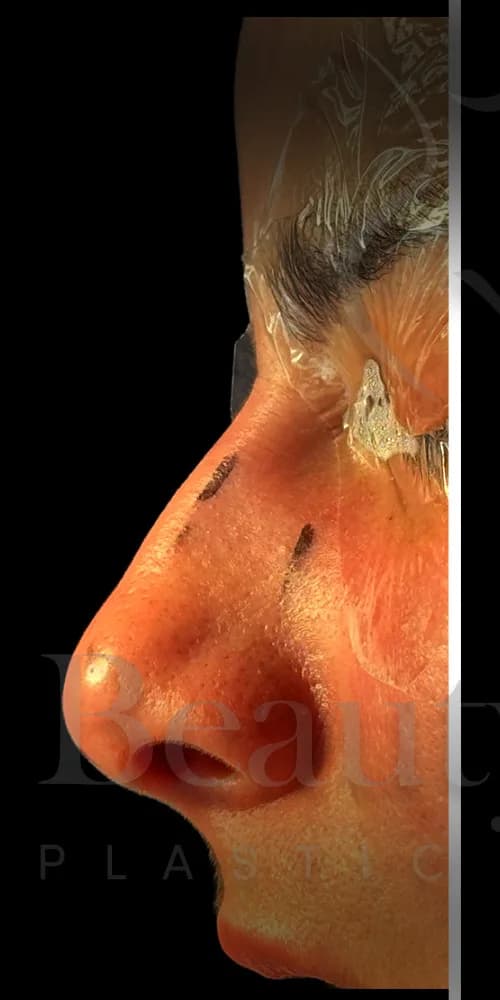 Rinoplastia antes por Dr. Oliver Simmons en Miami · Beautyland Plastic Surgery
