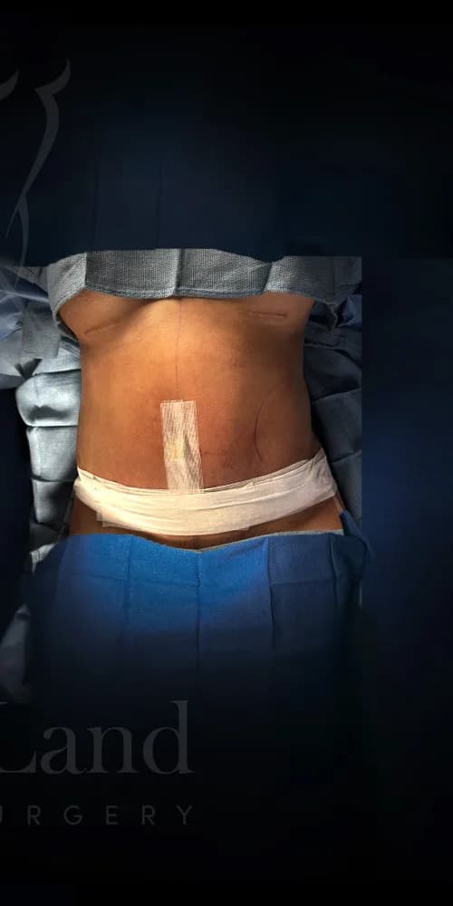 Abdominoplastia después por Dr. Anne-Sophie Lessard en Miami · Beautyland Plastic Surgery